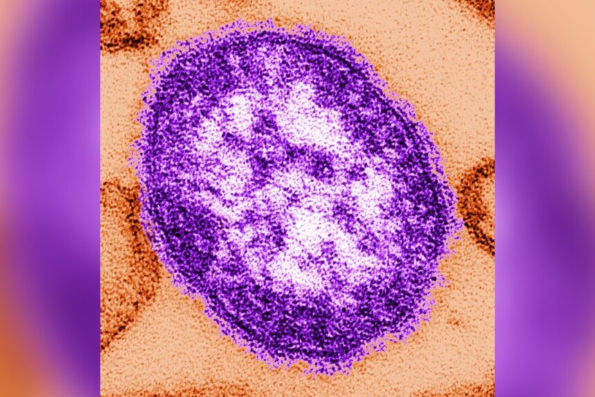 alberta-health-services-issues-measles-alert,-cases-reported-in-other-provinces