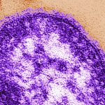 new-measles-case-count-on-decline-in-ontario,-public-health-data-indicates