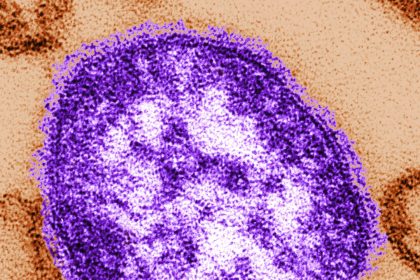 new-measles-case-count-on-decline-in-ontario,-public-health-data-indicates