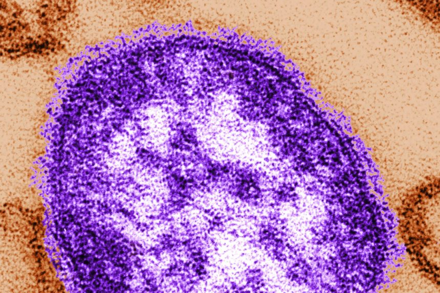 new-measles-case-count-on-decline-in-ontario,-public-health-data-indicates